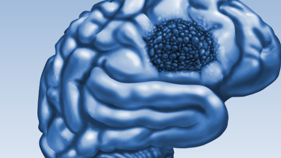 Síntomas, causas y tratamiento del glioblastoma Neurocirujano de Florida