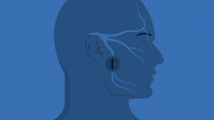 Microvascular_decompression