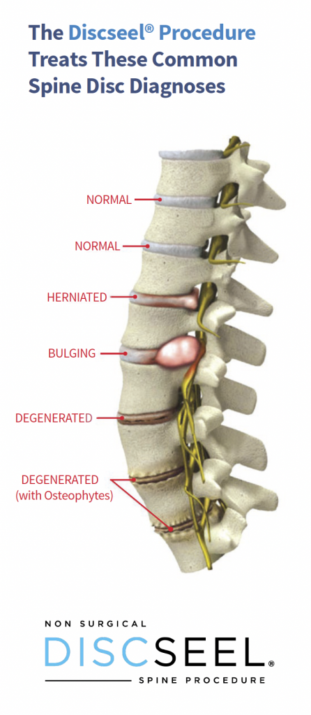 Discseel Procedure | Top Neurosurgeon